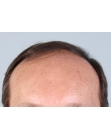 Before Hair Transplant &nbsp;Front